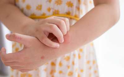 How to Get Rid of Eczema Hives? Complete Guide