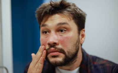 How to Stop Hives Permanently?