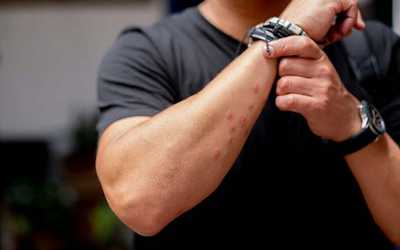 Insect Allergy Shots & Immunotherapy Options at Allergy Clinics