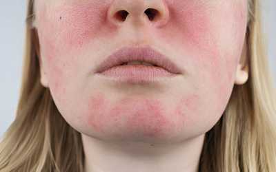 How Long Does Eczema Last With Treatment? Complete Guide