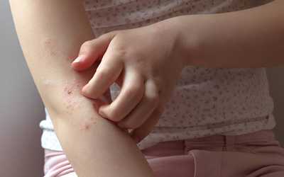 What Are the Best Treatments for Eczema?
